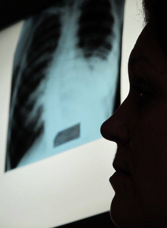 Antibiotikaresistente Tuberkulose IMG 7756 1